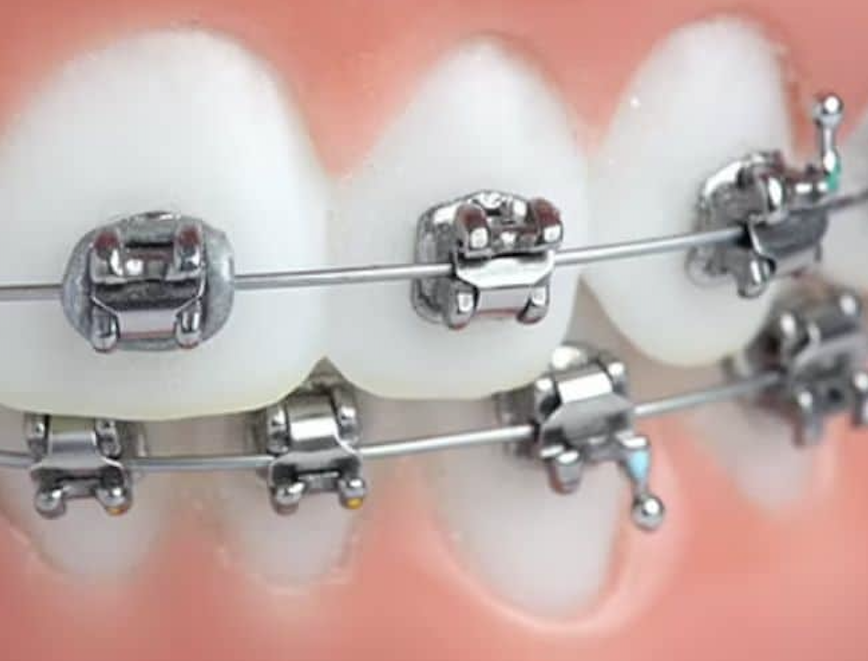 Faux palais - Appareil amovible