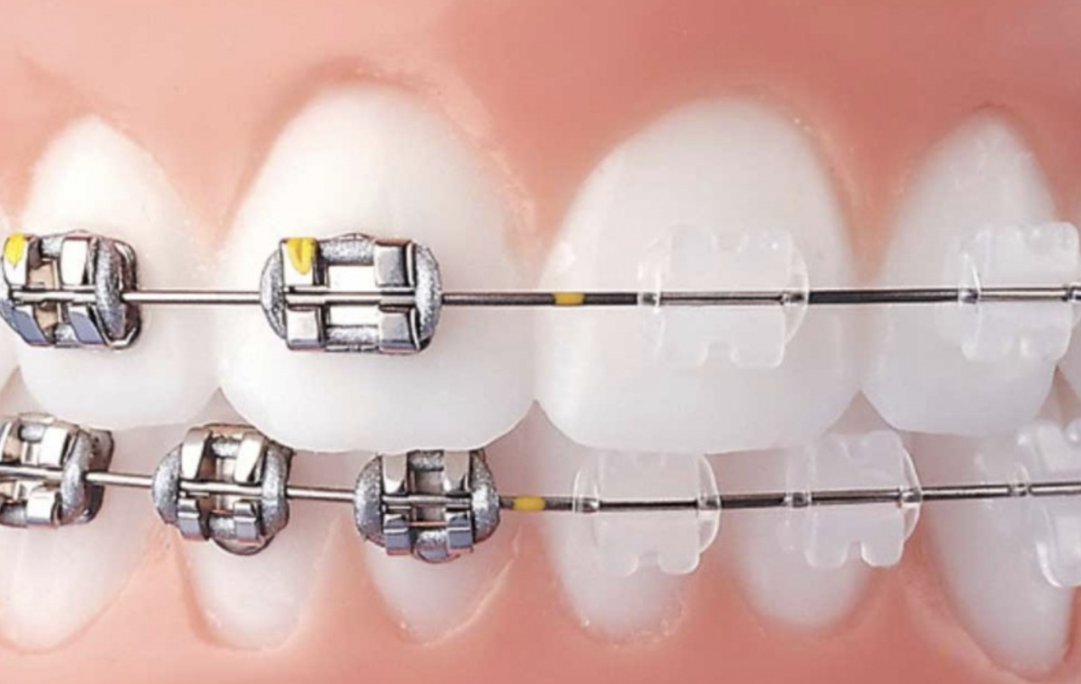 Faux palais - Appareil amovible